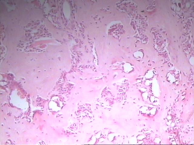 Adenoma pleomrfico de la mama - <div style=